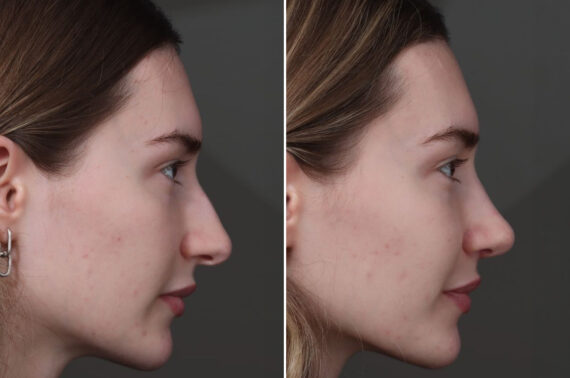 Rhinoplasty Before and After Photos in Princeton, NJ, Patient 19487