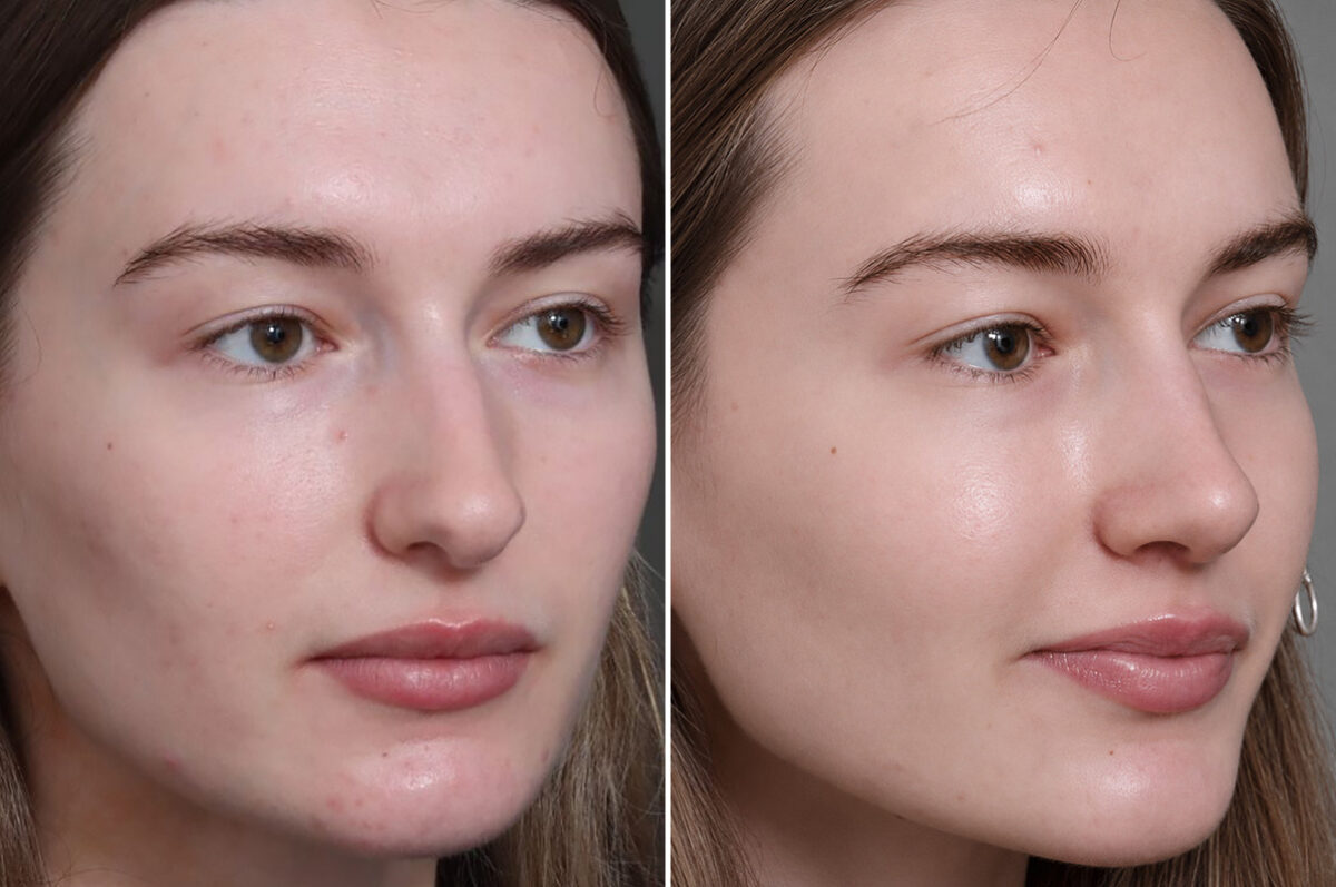 Rhinoplasty Before and After Photos in Princeton, NJ, Patient 19487
