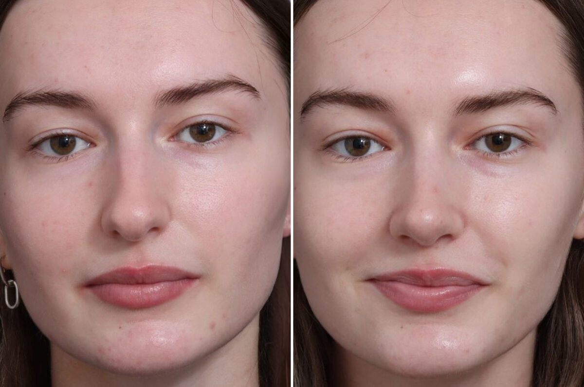 Rhinoplasty Before and After Photos in Princeton, NJ, Patient 19487