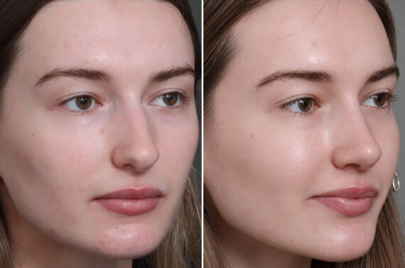 Rhinoplasty Before and After Photos in Princeton, NJ, Patient 19487