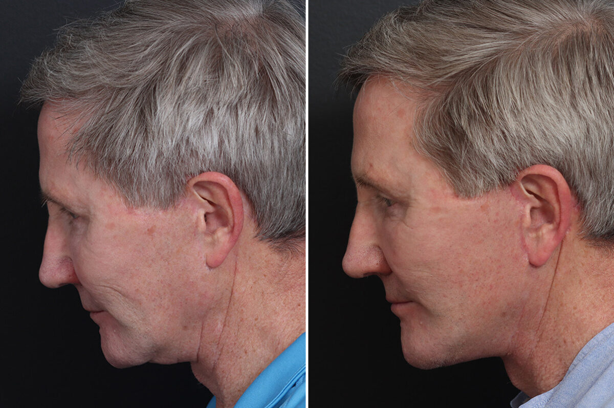Chin Implants Before and After Photos in Princeton, NJ, Patient 19005