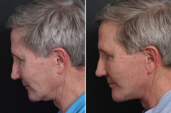 Chin Implants Before and After Photos in Princeton, NJ, Patient 19005