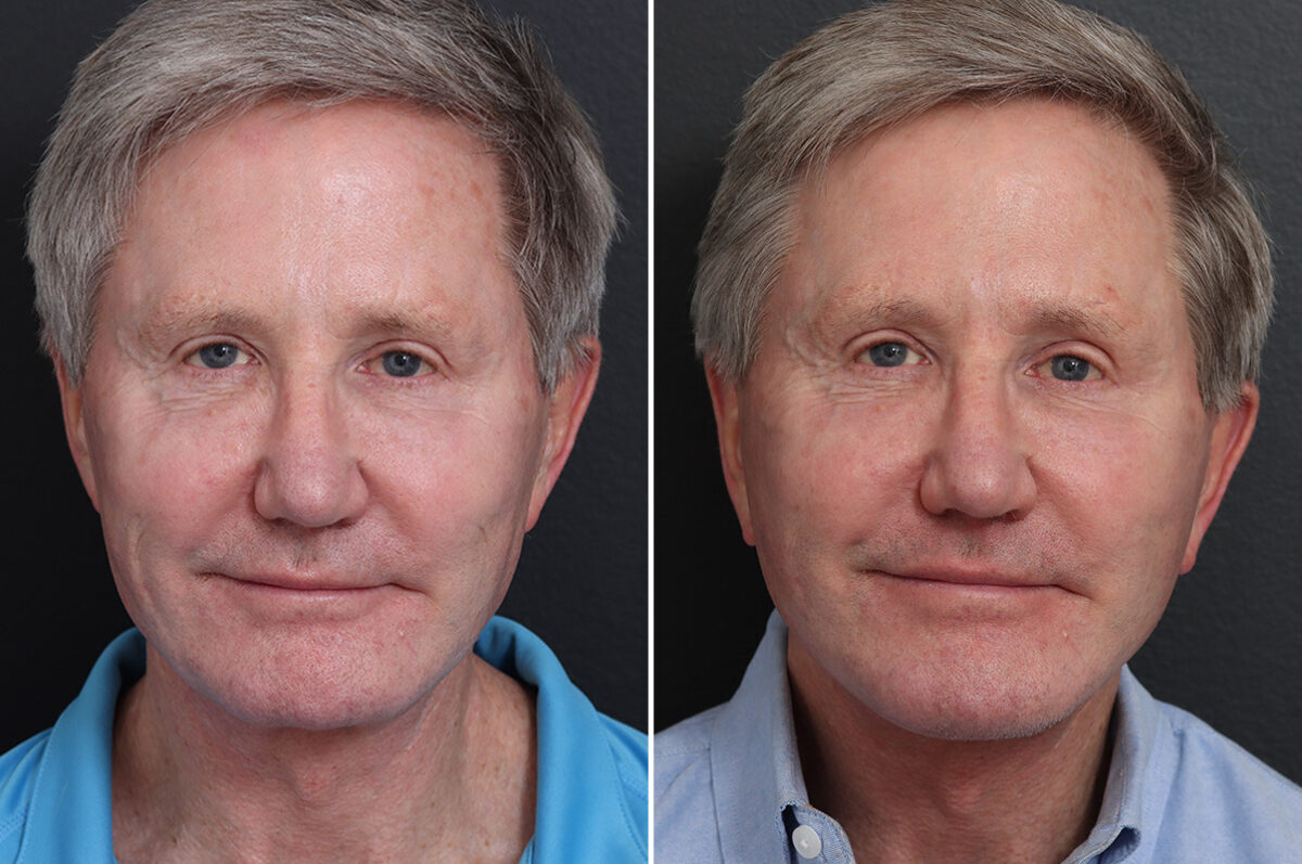 Chin Implants Before and After Photos in Princeton, NJ, Patient 19005