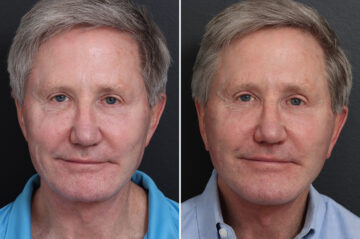 Chin Implants Before and After Photos in Princeton, NJ, Patient 19005