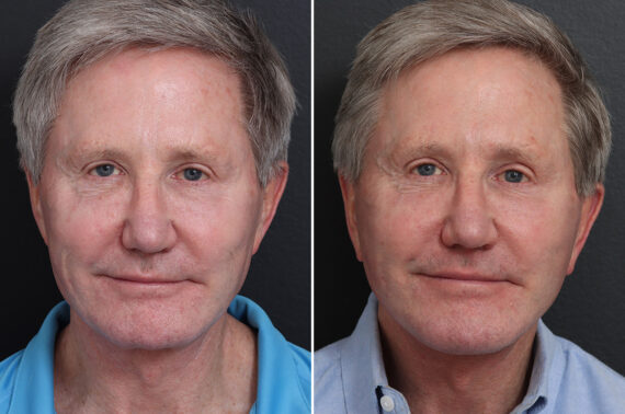 Chin Implants Before and After Photos in Princeton, NJ, Patient 19005