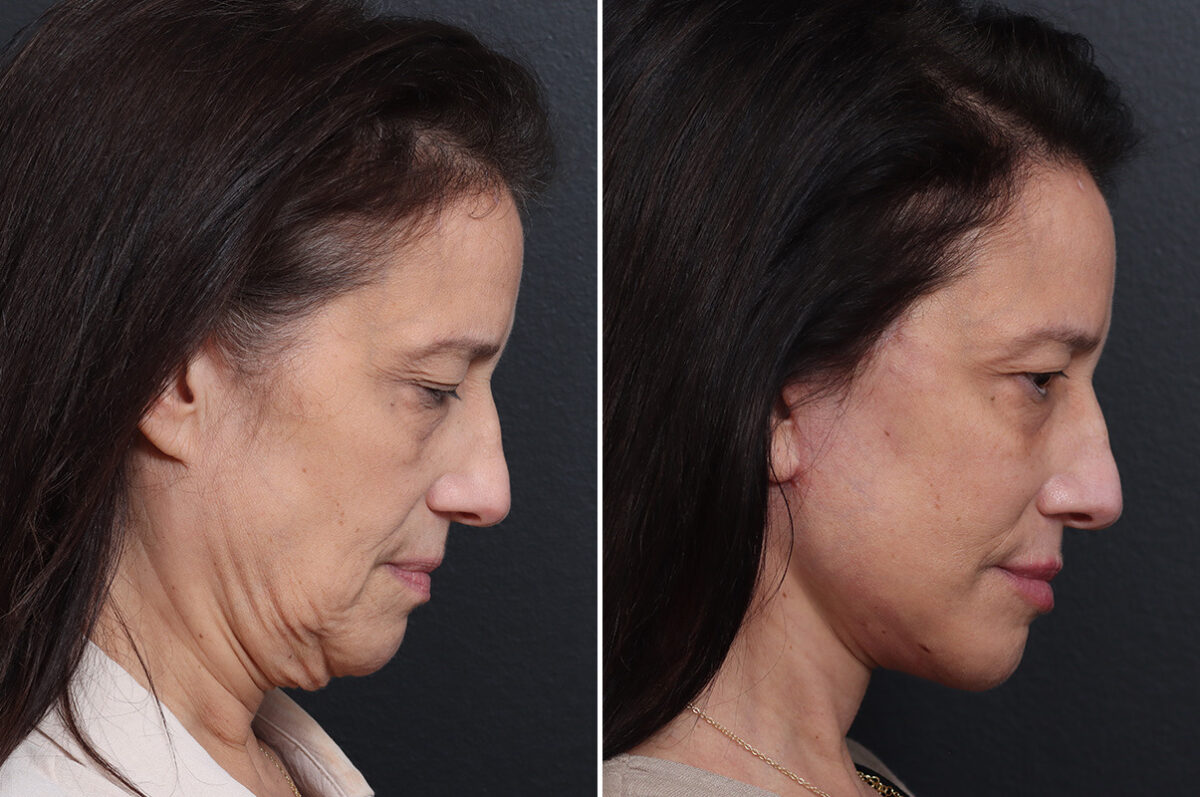 Deep Plane Facelift Before and After Photos in Princeton, NJ, Patient 19278