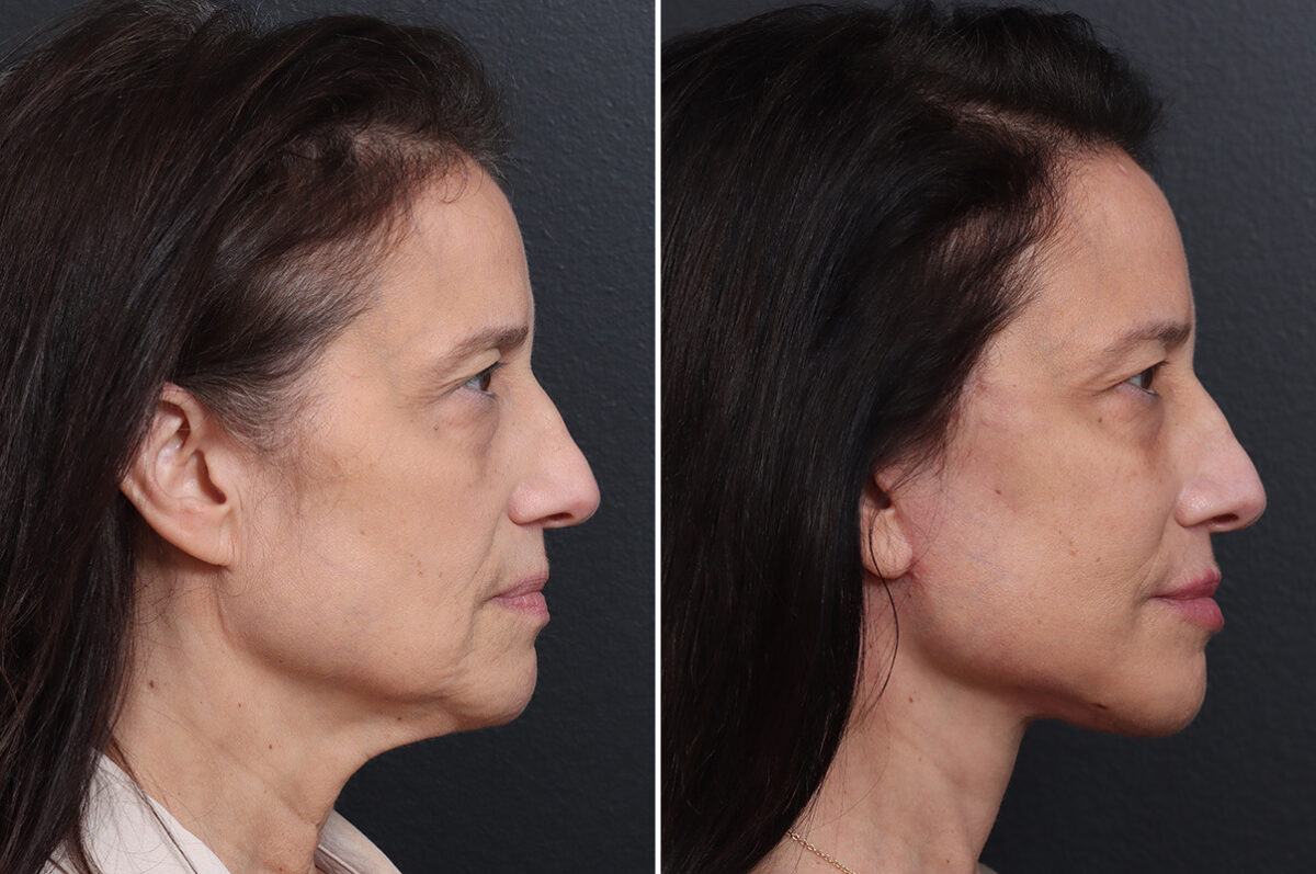 Deep Plane Facelift Before and After Photos in Princeton, NJ, Patient 19278