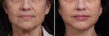 Deep Plane Facelift Before and After Photos in Princeton, NJ, Patient 19278
