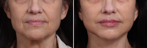 Deep Plane Facelift Before and After Photos in Princeton, NJ, Patient 19278