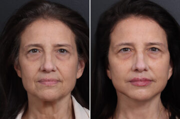 Facelift Before and After Photos in Princeton, NJ, Patient 19278