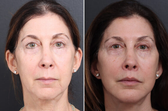Lip Lift Before and After Photos in Princeton, NJ