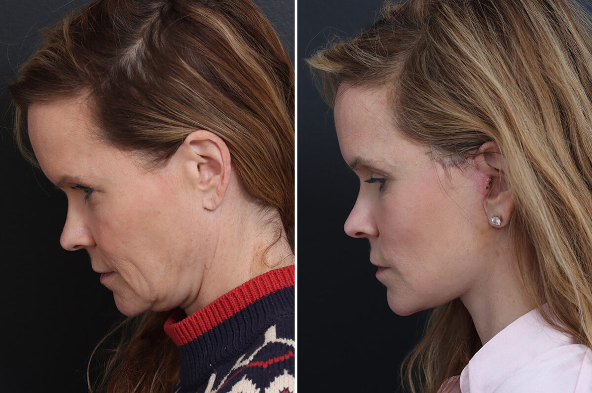 Facelift Before and After Photos in Princeton, NJ, Patient 20192