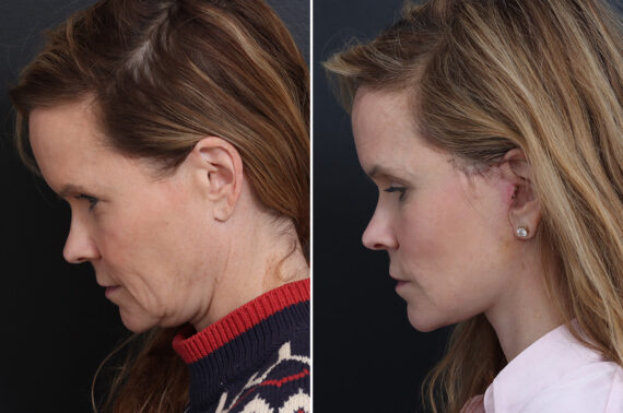 Facelift Before and After Photos in Princeton, NJ, Patient 20192