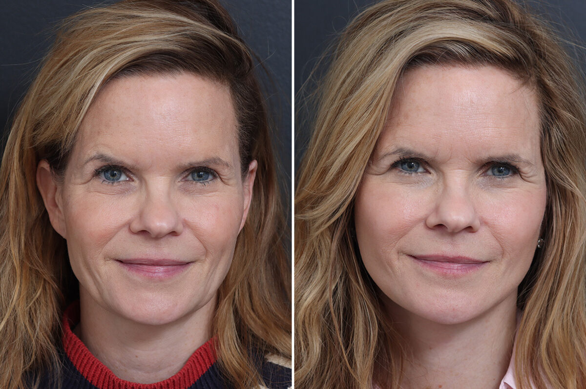 Facelift Before and After Photos in Princeton, NJ, Patient 20192