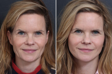Facelift Before and After Photos in Princeton, NJ, Patient 20192